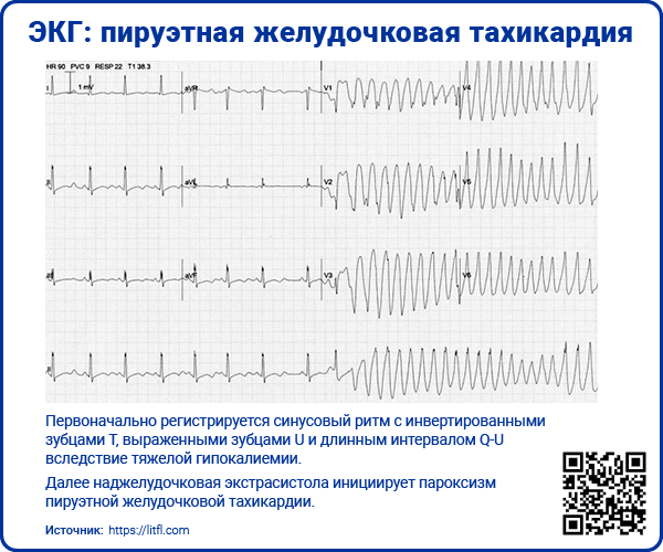 ЭКГ пируэтная желудочковая тахикардия